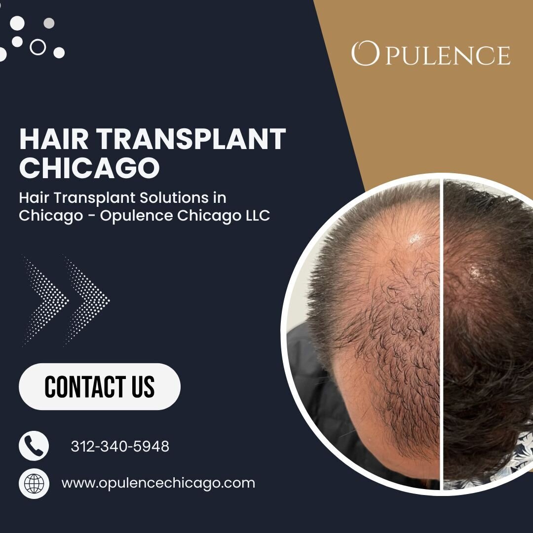 Hair Transplant Solutions in Chicago - Opulence Chicago LLC